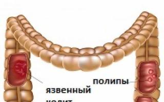 После поноса проявилась кровь на туалетной бумаге: как помочь своему организму?